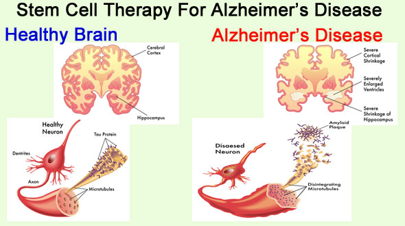alzheimer alzheimer